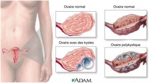 u nang buồng trứng