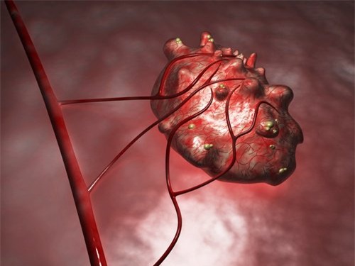 u nang buồng trứng