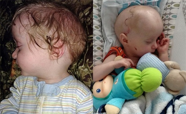 Em bé đầu dẹt sống sót đầy kì tích sau khi hộp sọ được đập ra rồi ghép lại - Ảnh 1.