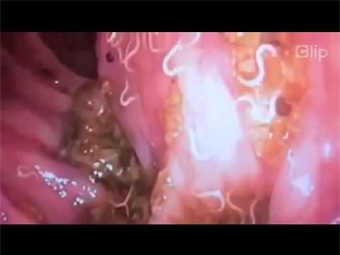 Giun lươn: Loài vật tàn sát sức khoẻ ghê sợ - Ảnh 2.