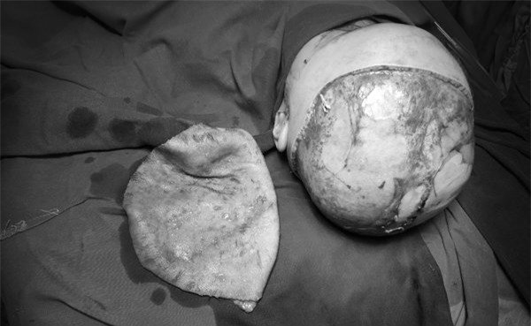 lột da đầu, ghép da đầu, tai nạn giao thông