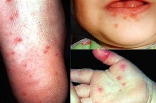 Nhà có trẻ nhỏ cần tránh bệnh này khi thời tiết giao mùa - Ảnh 2.