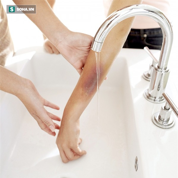 BS hướng dẫn cách xử lý khi bị bỏng, hãy lưu lại lời khuyên này - Ảnh 5.