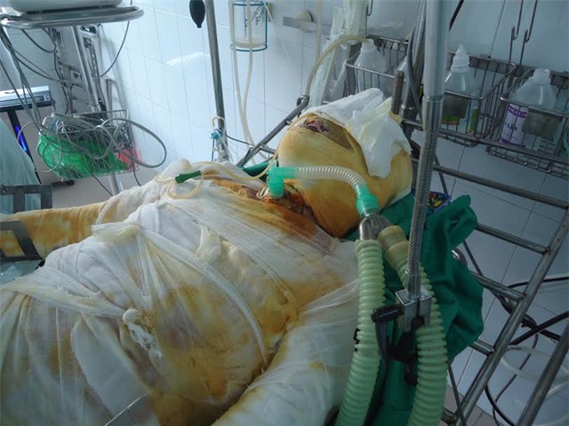 BS hướng dẫn cách xử lý khi bị bỏng, hãy lưu lại lời khuyên này - Ảnh 7.