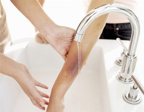 ba bat can, chau be 4 tuoi phai nhap vien vi bi bong hop my tom - 1