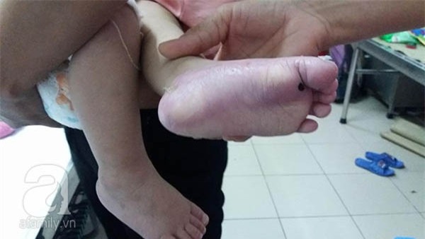 bé bị bỏng toàn thân