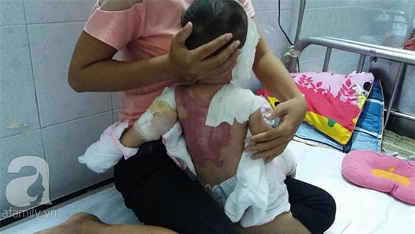 bé bị bỏng toàn thân