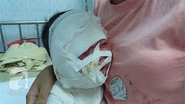 bé bị bỏng toàn thân