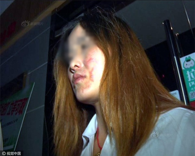 Trung Quốc: Đi ăn lẩu, cô gái bất ngờ bị nhân viên cửa hàng làm cháy mặt - Ảnh 2.