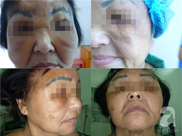 Bom silicon long hon chuc nam truoc, nhung phu nu nay gio day vo cung hoi han