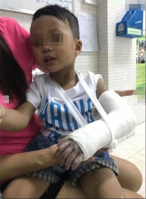 Nghi vấn bé trai bị cô giáo mầm non đánh gãy tay.