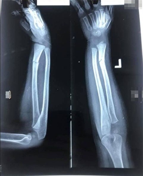 Ảnh chụp X Quang tay trái bị gãy của bé trai.