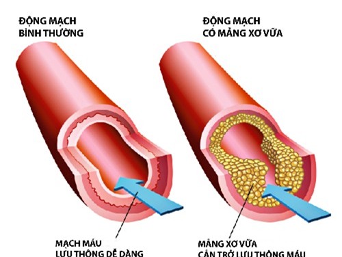 3 dấu hiệu của mỡ máu - căn bệnh giết người âm thầm: Dù gầy hay béo đều phải cảnh giác - Ảnh 3.