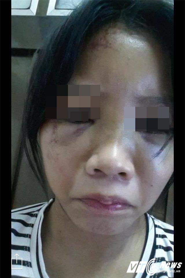 Nữ sinh run sợ kể phút bị bạn châm thuốc lá vào tay, bắt liếm chân - Ảnh 2.