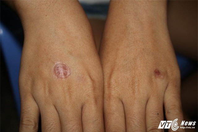 Nữ sinh run sợ kể phút bị bạn châm thuốc lá vào tay, bắt liếm chân - Ảnh 3.