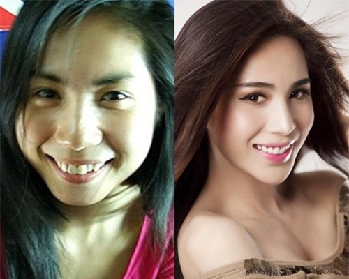 Kết quả hình ảnh cho thủy tiên phẫu thuật