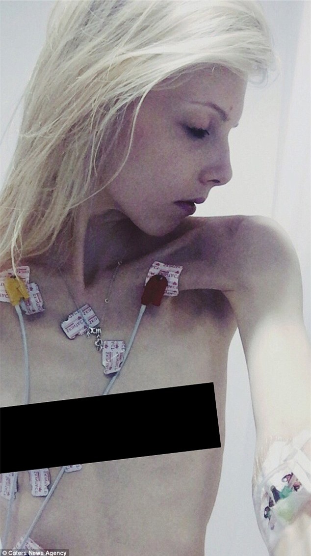 Từ bộ xương khô 34kg, cô gái mắc bệnh trầm cảm và biếng ăn nay đã trở nên vô cùng xinh đẹp - Ảnh 1.