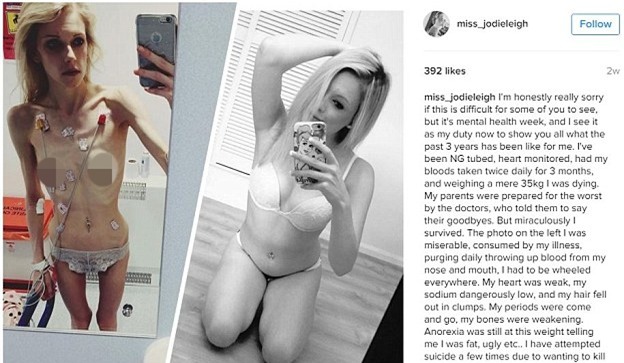 Từ bộ xương khô 34kg, cô gái mắc bệnh trầm cảm và biếng ăn nay đã trở nên vô cùng xinh đẹp - Ảnh 9.