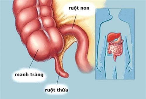 14 tuổi mổ gấp vì đau ruột thừa: Cảnh báo nguy cơ chết người từ hạt ổi - Ảnh 1.