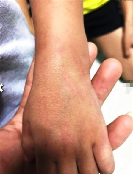 Hính ảnh cháu bé bó bột và có về lằn trên tay được gia đình đăng tải trên Facebook trước khi tháo gỡ