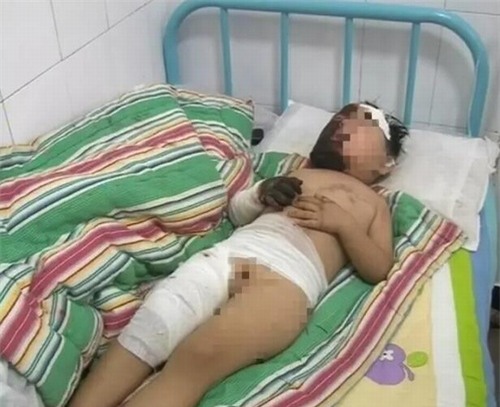 chi mot chut lo la cua nguoi lon, be trai 3 tuoi bi nga vao chao dau dang soi - 2