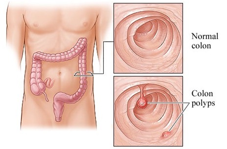 Chuyên gia ung thư cảnh báo: Sau 40 tuổi, 100% người mắc bệnh này sẽ chuyển thành ung thư - Ảnh 2.