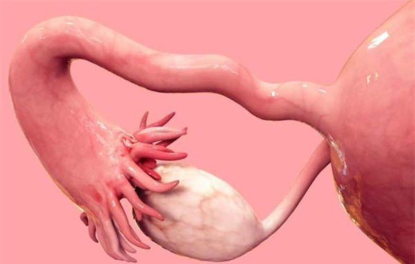 béo phì gây ung thư