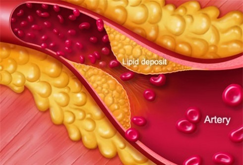 Tình trạng mỡ trong máu gây hẹp mạch máu