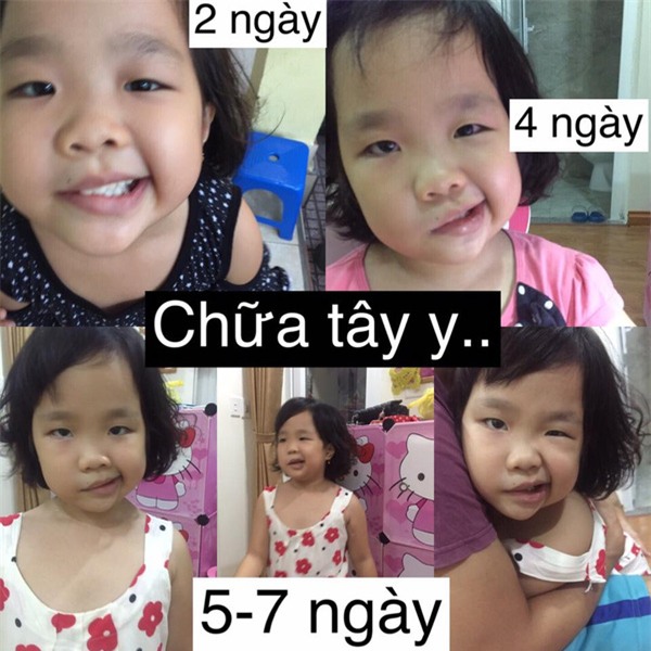 Hành trình 40 ngày lấy lại khuôn mặt cho con và cảnh báo cha mẹ nào cũng nên biết - Ảnh 2.