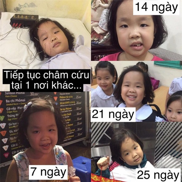 Hành trình 40 ngày lấy lại khuôn mặt cho con và cảnh báo cha mẹ nào cũng nên biết - Ảnh 4.