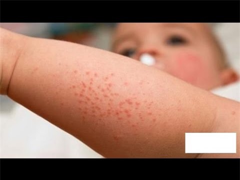 
Trẻ bị sốt xuất huyết cần được dùng panacetamol để hạ sốt, không dùng aspirin, ibuprofen
