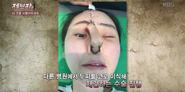 Phẫu thuật thẩm mỹ hỏng, cô gái Hàn Quốc nhận hậu quả đáng sợ - Ảnh 1.