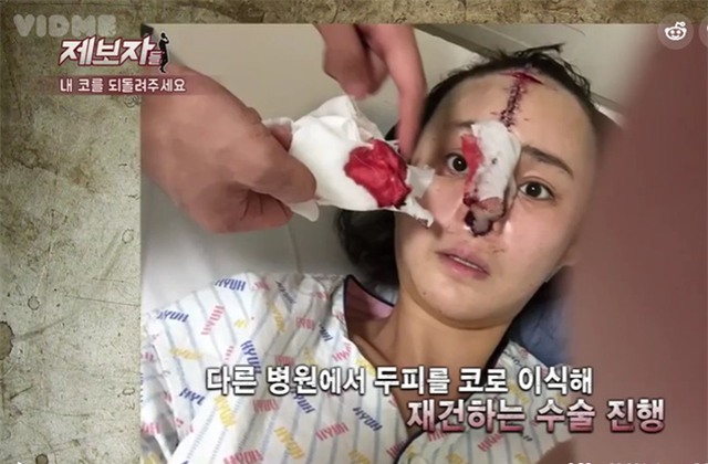 Phẫu thuật thẩm mỹ hỏng, cô gái Hàn Quốc nhận hậu quả đáng sợ - Ảnh 4.