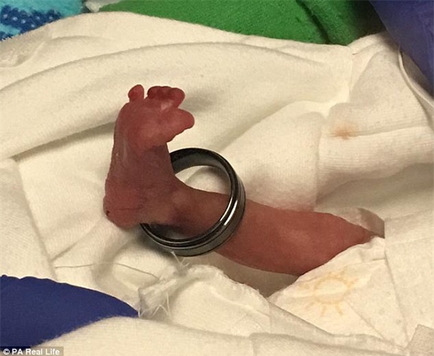 Sức sống kỳ diệu của em bé sinh non 21 tuần tuổi nặng có 400g, bàn chân lọt thỏm trong chiếc nhẫn - Ảnh 1.