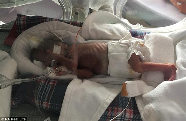 Sức sống kỳ diệu của em bé sinh non 21 tuần tuổi nặng có 400g, bàn chân lọt thỏm trong chiếc nhẫn - Ảnh 2.