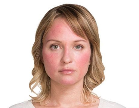 Image result for Skin redness
