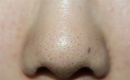 tu lam gel lot mun de loi bang sach tat ca mun cam, mun dau den tren mui - 1