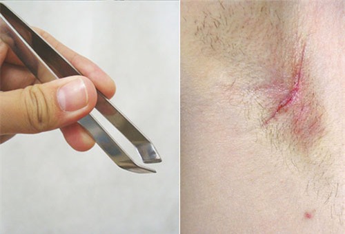 cach diet tan goc long nach moc li ti ngua ngay bang hon hop re beo - 1