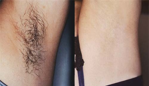 cach diet tan goc long nach moc li ti ngua ngay bang hon hop re beo - 5