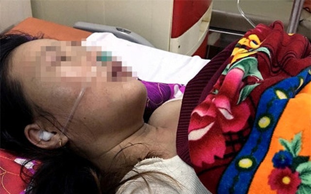 Chồng đánh vợ tổn thương sọ não, nhập viện cấp cứu