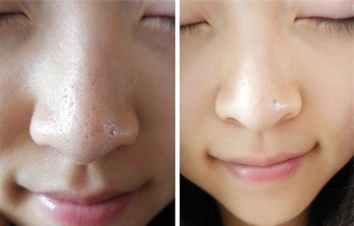 nuoc-cot-chanh-tri-mun-duong-da-blogtamsuvn8