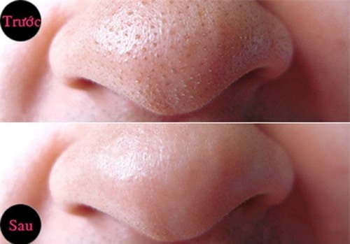 nuoc-cot-chanh-tri-mun-duong-da-blogtamsuvn7