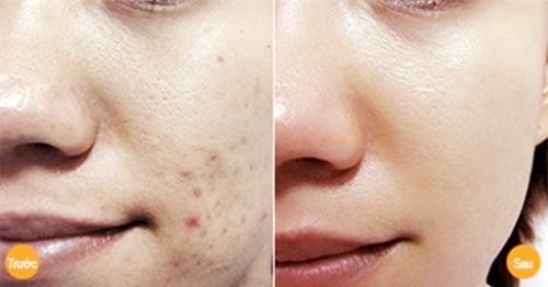 bot-nghe-duong-da-blogtamsuvn5a