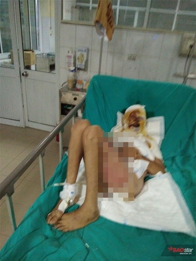 Do bị bỏng quá nặng (trên 95%) nên hai vợ chồng bán nước khó qua khỏi.