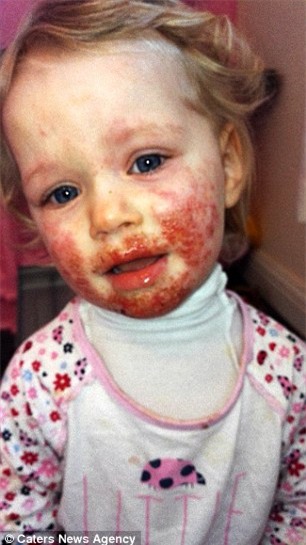 Khuôn mặt bé gái 2 tuổi như bị tạt axit: Đau lòng khi lỗi do thói quen của người lớn - Ảnh 1.