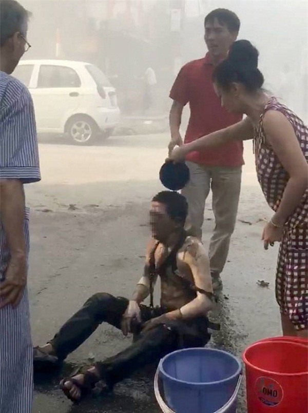 sơ cứu khi bị bỏng