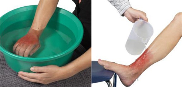 sơ cứu đúng cách khi bị bỏng