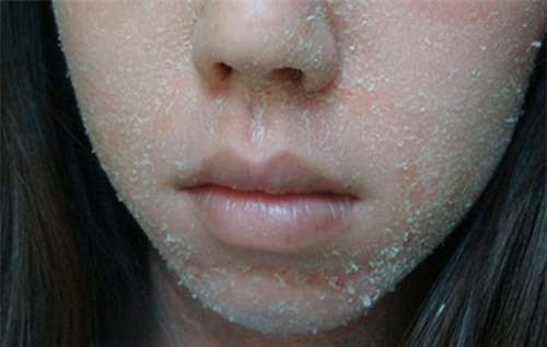 co bi kip nay roi, chang bao gio lo da bong troc, nut ne hay trang diem bi moc nua - 1