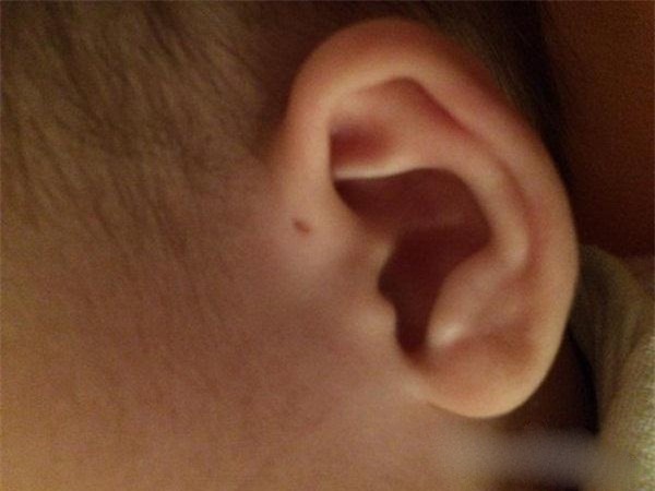 Lỗ nhỏ như đầu kim ở vành tai con, bố mẹ hãy cẩn thận kẻo có biến chứng khôn lường - Ảnh 2.