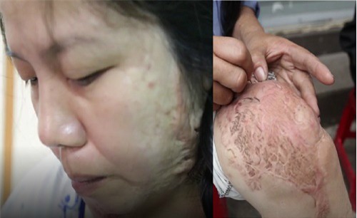 sau bao dau don kinh hoang, nguòi phụ nũ bị tạt axit mong chò ngay ke ac den toi - 1